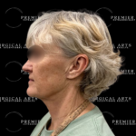 Neck Lift Before & After Patient #2323
