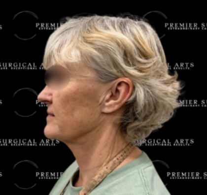 Neck Lift Before & After Patient #2323