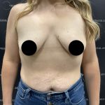 Breast Augmentation + Lift Before & After Patient #2347