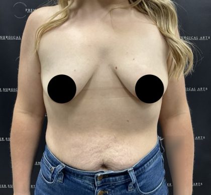 Breast Augmentation + Lift Before & After Patient #2347