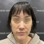 Blepharoplasty Before & After Patient #2354