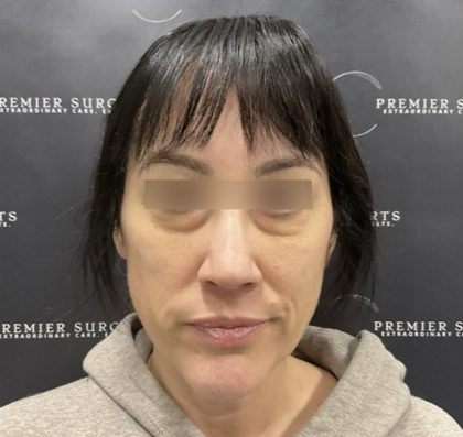 Blepharoplasty Before & After Patient #2354