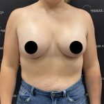 Breast Augmentation + Lift Before & After Patient #2347