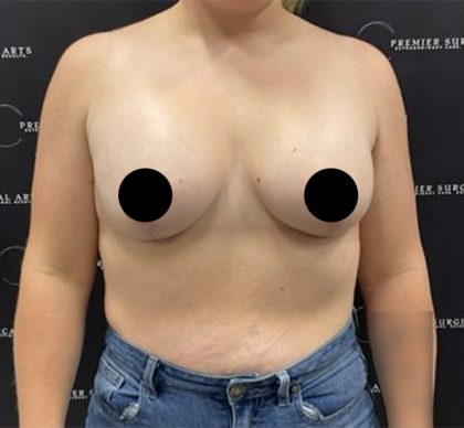 Breast Augmentation + Lift Before & After Patient #2347