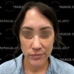 Blepharoplasty Before & After Patient #2354