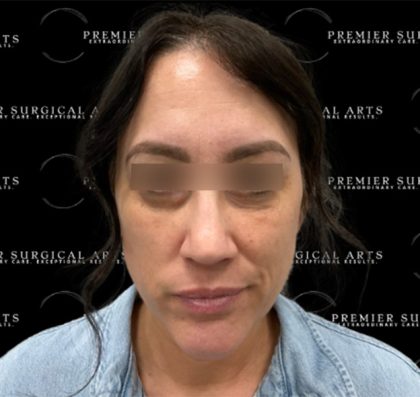 Blepharoplasty Before & After Patient #2354