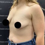 Breast Augmentation + Lift Before & After Patient #2347