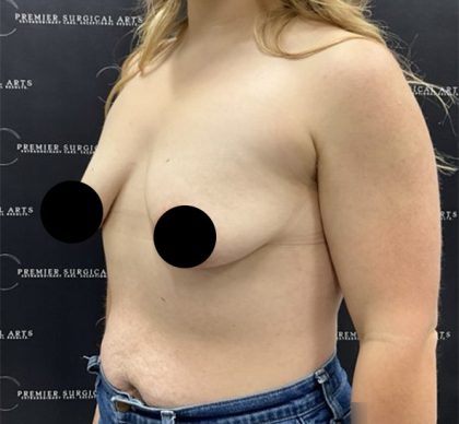Breast Augmentation + Lift Before & After Patient #2347