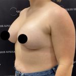 Breast Augmentation + Lift Before & After Patient #2347