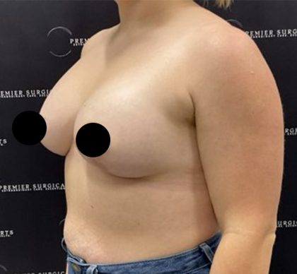 Breast Augmentation + Lift Before & After Patient #2347