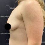Breast Augmentation + Lift Before & After Patient #2347