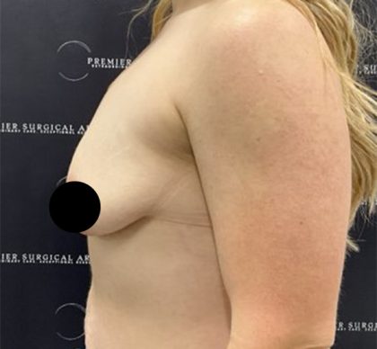 Breast Augmentation + Lift Before & After Patient #2347