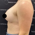 Breast Augmentation + Lift Before & After Patient #2347