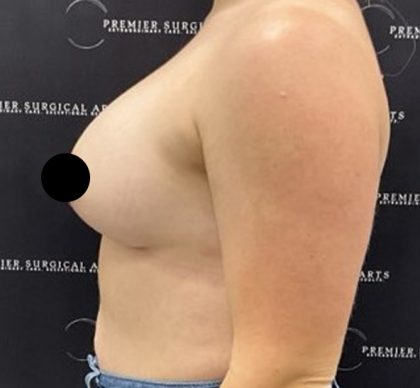 Breast Augmentation + Lift Before & After Patient #2347
