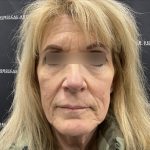 Deep Plane Facelift Before & After Patient #2371