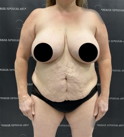Liposuction Before & After Patient #2430