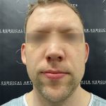 Otoplasty Before & After Patient #2429