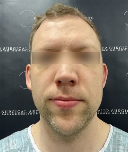 Otoplasty Before & After Patient #2429