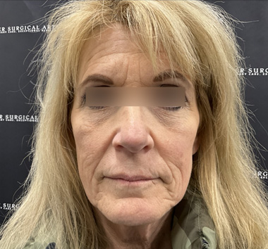 Deep Plane Facelift Before & After Patient #2371