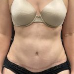 Medial Thigh Liposuction Before & After Patient #2394