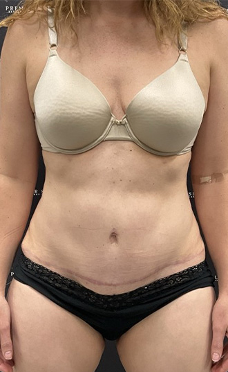 Medial Thigh Liposuction Before & After Patient #2394