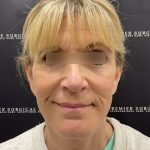 Deep Plane Facelift Before & After Patient #2371