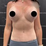 Liposuction Before & After Patient #2422