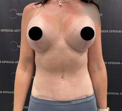 Liposuction Before & After Patient #2422