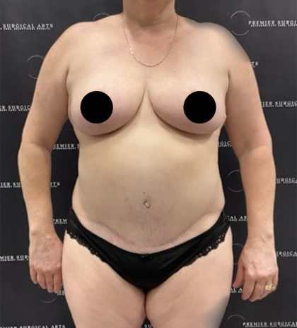 Liposuction Before & After Patient #2430