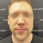 Otoplasty Before & After Patient #2429