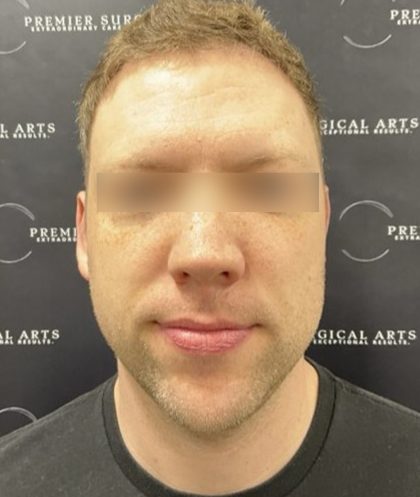 Otoplasty Before & After Patient #2429