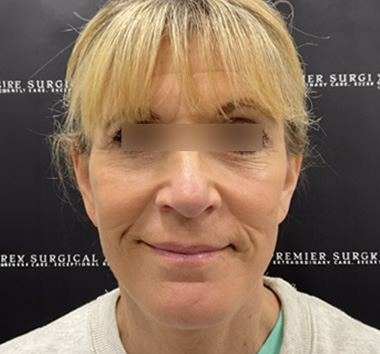 Deep Plane Facelift Before & After Patient #2371
