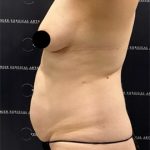Medial Thigh Liposuction Before & After Patient #2394