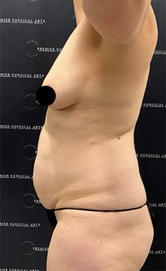 Medial Thigh Liposuction Before & After Patient #2394