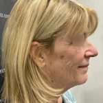 Deep Plane Facelift Before & After Patient #2371