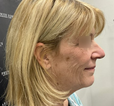 Deep Plane Facelift Before & After Patient #2371