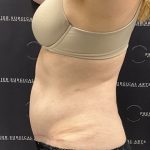 Medial Thigh Liposuction Before & After Patient #2394