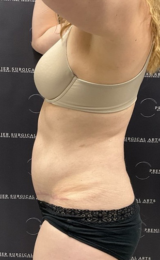 Medial Thigh Liposuction Before & After Patient #2394
