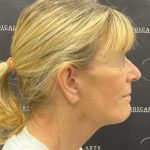 Deep Plane Facelift Before & After Patient #2371