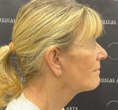 Deep Plane Facelift Before & After Patient #2371