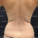 Medial Thigh Liposuction Before & After Patient #2394