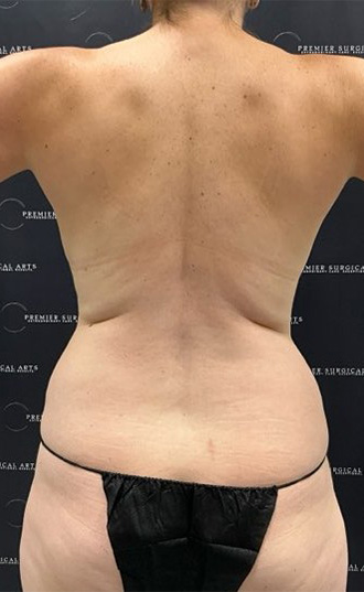 Medial Thigh Liposuction Before & After Patient #2394