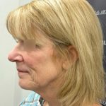 Deep Plane Facelift Before & After Patient #2371