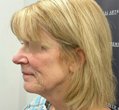 Deep Plane Facelift Before & After Patient #2371