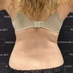 Medial Thigh Liposuction Before & After Patient #2394