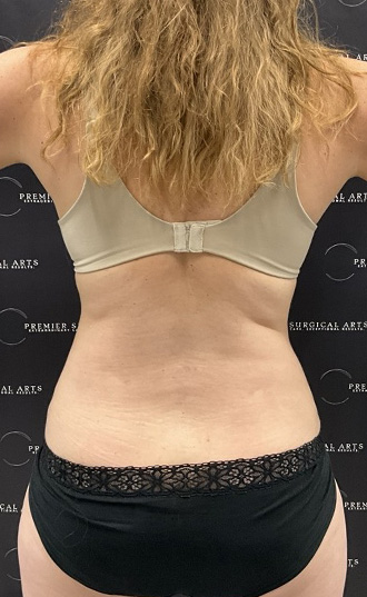 Medial Thigh Liposuction Before & After Patient #2394