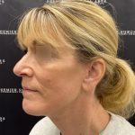 Deep Plane Facelift Before & After Patient #2371