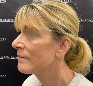 Deep Plane Facelift Before & After Patient #2371