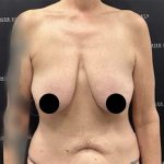 Liposuction Axilla Before & After Patient #2407