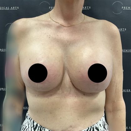 Liposuction Axilla Before & After Patient #2407